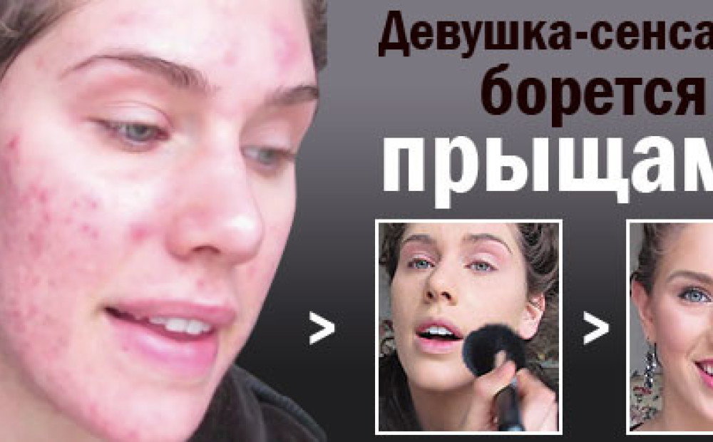 Прыщи на лице кто как борется с Прыщи на лице кто как борется с