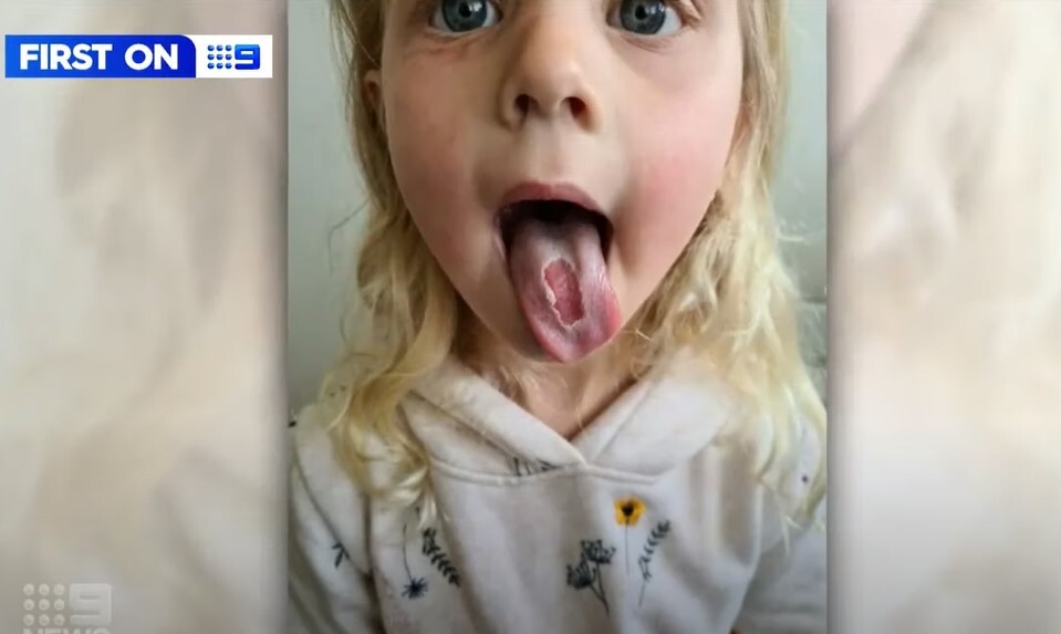 Что делать при обожженном языке кислой конфетой