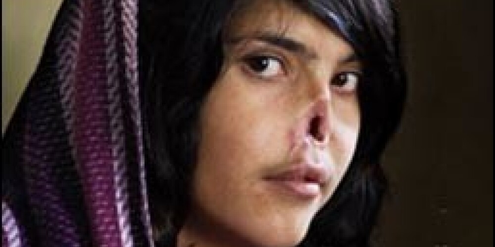 Изуродованная афганская девочка-подросток потрясла мир