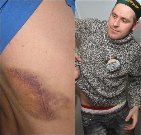 Похоже, Фрейманис научился относиться философски к своей травматичности. По поводу очередных увечий он уже не так сильно переживает и с удовольствием демонстрирует их знакомым