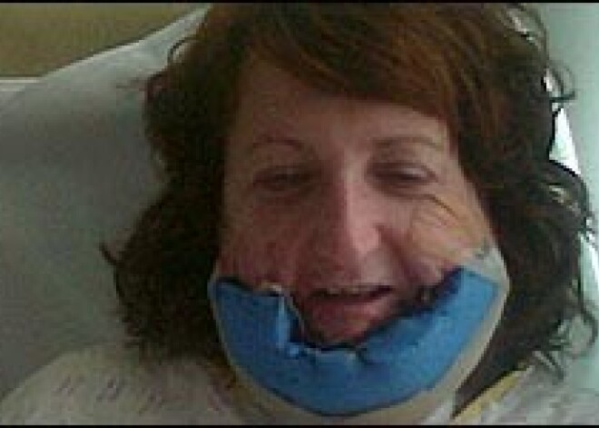 Женщина выжила после страшных ожогов и стала сильнее