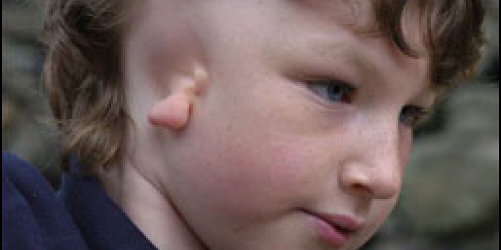 Мальчику сделали ухо из тканей грудной клетки
