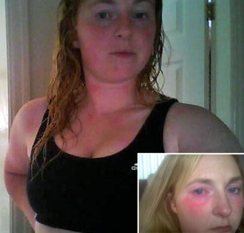 Женщина не может плакать, а после душа должна восстанавливаться два часа от зудящей болезненной сыпи