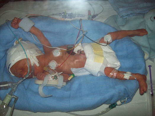 Состояние малыша было крайне тяжелым