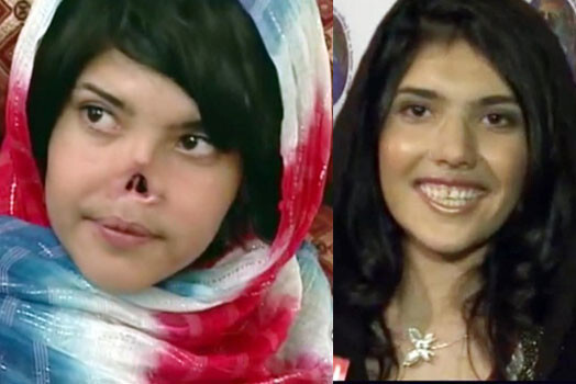 Пока Аиша носит специальный протез, скрывающий отсутствие носа