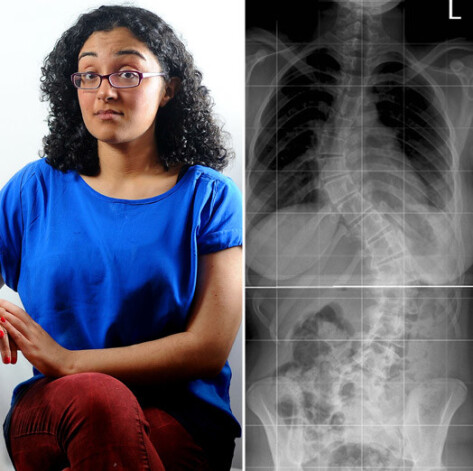 Теперь у девушки хорошая осанка, а раньше ее позвоночник выглядел чудовищно