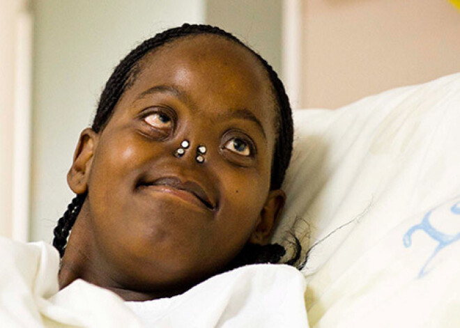 Девушке без носа сделали операцию