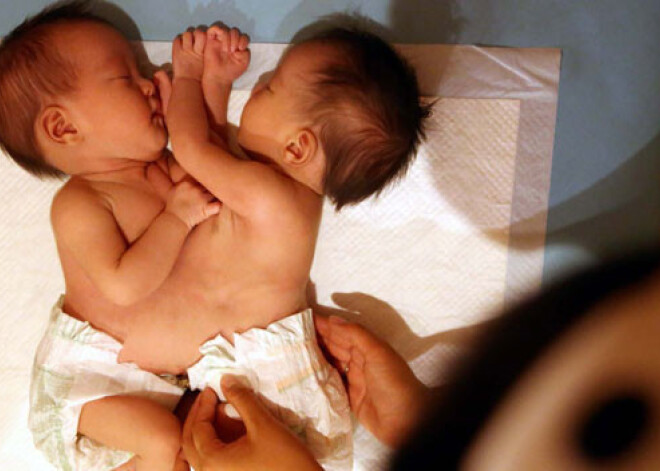 Младенцев-сиамских близнецов бросили на улице