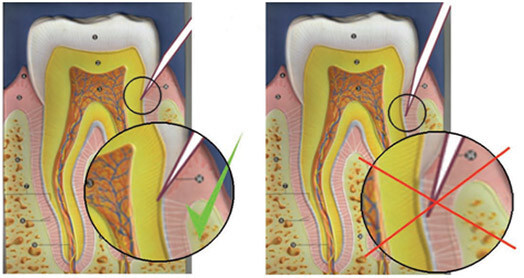 Attēla redzama adatas pozīcija smaganas rievā Wand STA intraligamentārās anestēzijas laikā. Adata periodonta audos netiek durta.