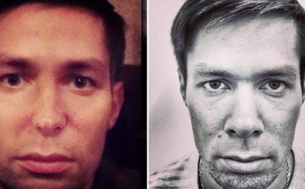 Батрутдинов пластика лица фото до и после Батрутдинов пластика лица фото до и после