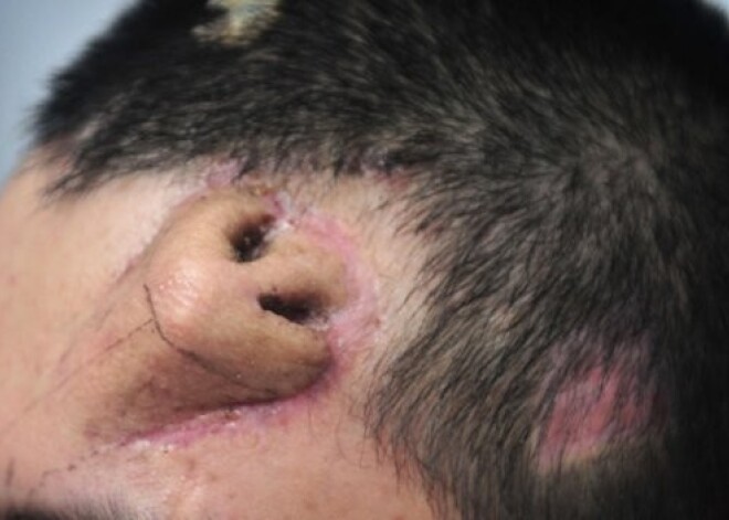 Китайские ученые вырастили новый нос на лбу пациента