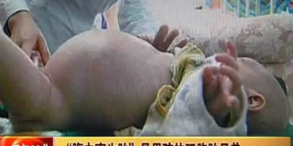 В Китае двухлетний мальчик «родил» брата-близнеца. ВИДЕО