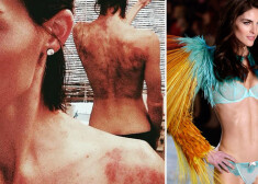 Супермодель Хилари Рода надеется с помощью лечения банками избавиться от боли в спине и шее