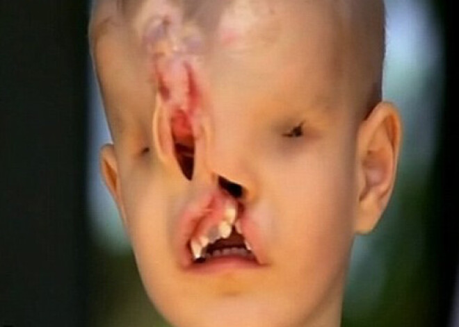 Мальчик без лица получит шанс на нормальную жизнь. ВИДЕО