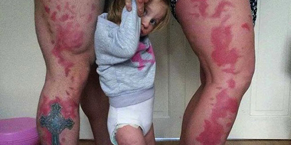 Родители сделали татуировки, как родимые пятна у их дочери
