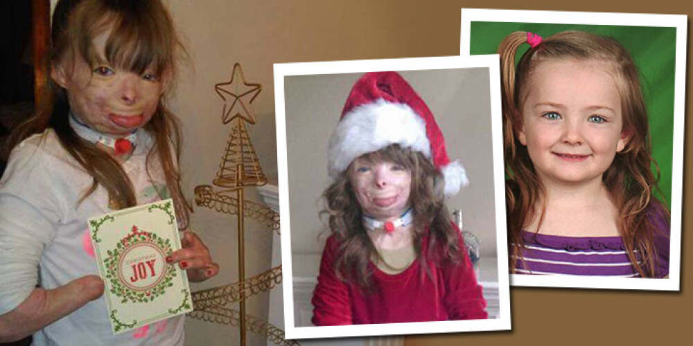 Девочка с тяжелыми ожогами просит на Рождество праздничные открытки