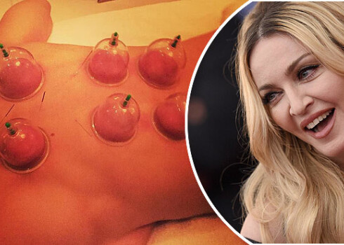 Мадонна, оказывается, тоже лечится банками