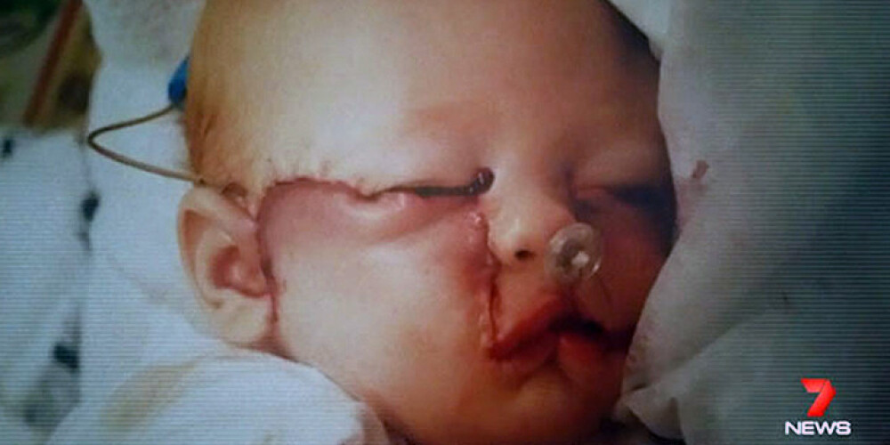 Хирурги создали лицо девочки, родившейся без его части