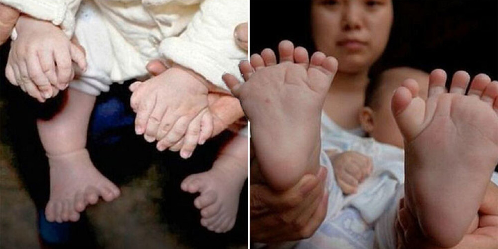 Ķīnā piedzimis bērns ar 31 pirkstu,  bet bez īkšķiem. VIDEO