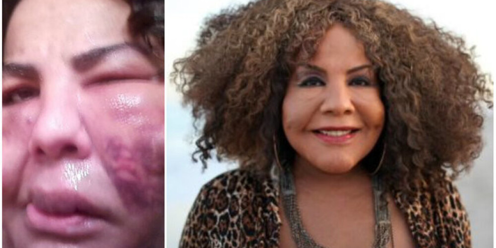 Pēc 10 gadiem "cementa sejas sievietei" izdevies atgūt normālu izskatu. VIDEO