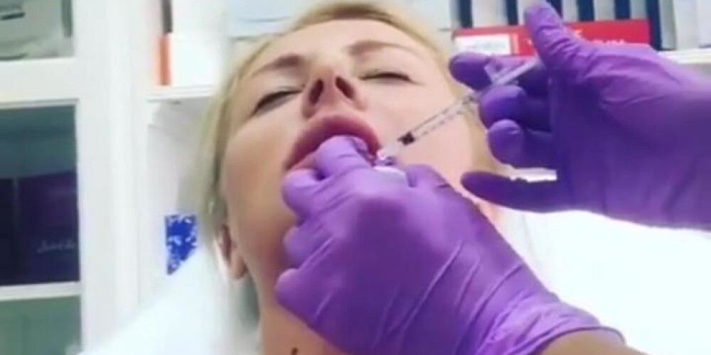 Дарья Пынзарь показала, как плачет в кабине у врача, избавляясь от искусственных губ. ВИДЕО