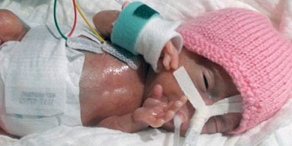 Самый маленький выживший новорожденный в мире родился с весом 236 граммов