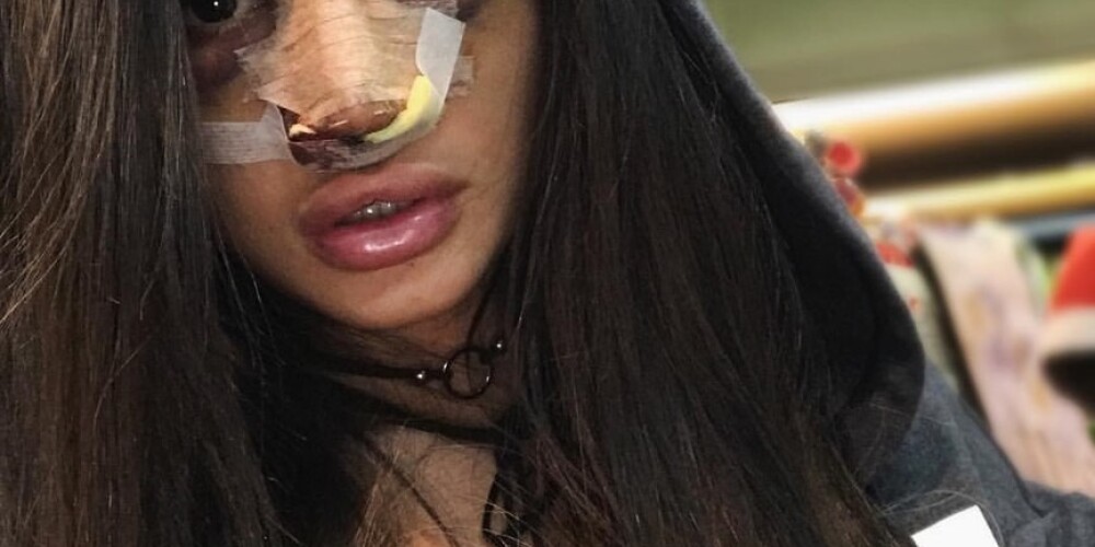 Марина Мексика шокировала снимком после пластики носа