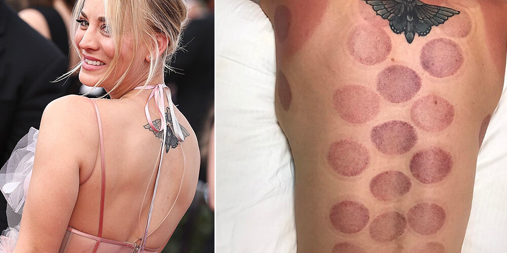 Кейли Куоко, оказывается, тоже лечится банками