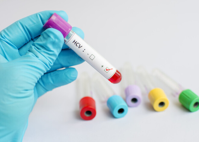 10 fakti par kluso slepkavu – C hepatītu