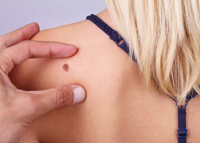 Vājprāts: ādas vēža pacientiem jārēķinās ar ārstēšanas izmaksām vismaz 14 000 eiro apmērā