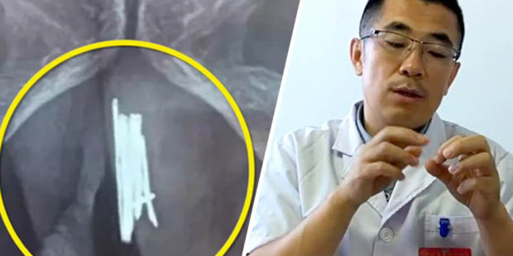 Vecpuisis Ķīnā savā loceklī salādē 15 adatas - tīri tā, baudai