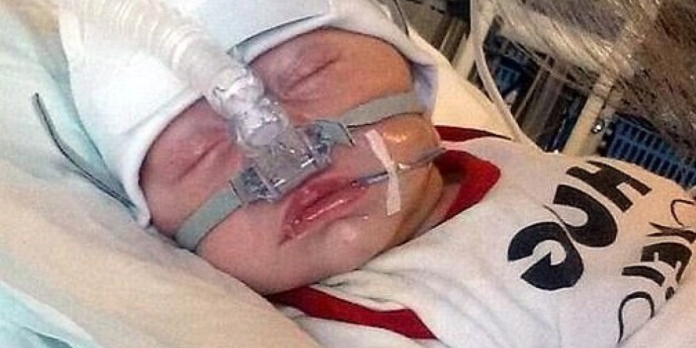 Трехнедельный малыш получил страшный ожог от подгузников