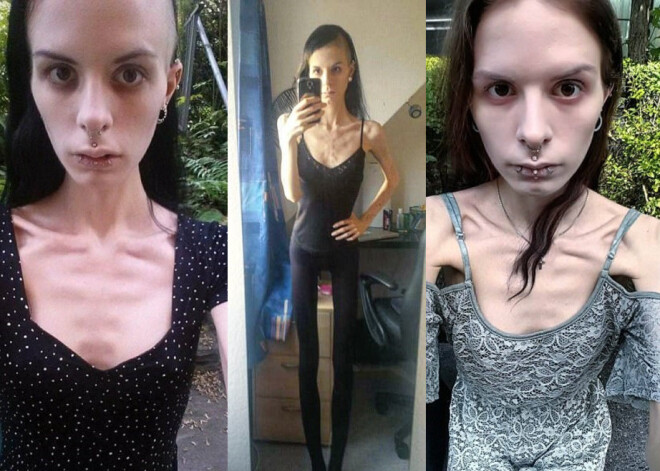 «Я знала, что мое время заканчивается», — говорит девушка, чуть не погибшая от анорексии