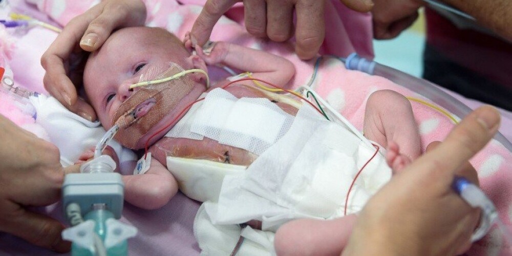 Lielbritānijā piedzimis mazulis ar sirdi ārpus ķermeņa