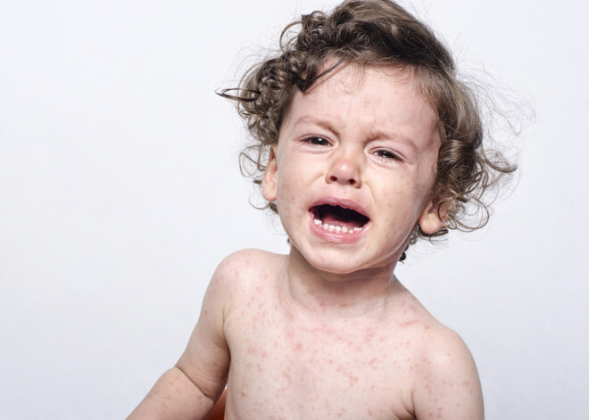 В Латвии начали болеть корью. Стоит ли опасаться?