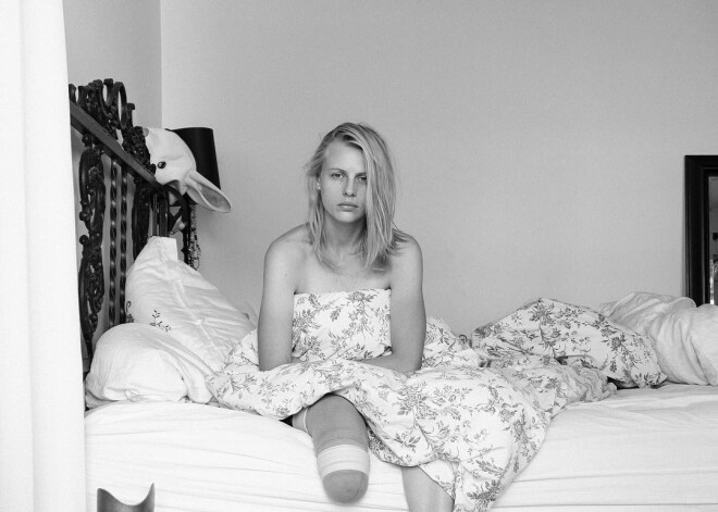 Jauna sieviete higiēniskā tampona dēļ zaudējusi abas kājas