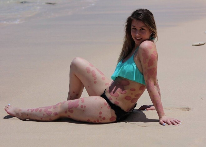 21-летняя девушка с псориазом: "Я приняла это как часть себя"