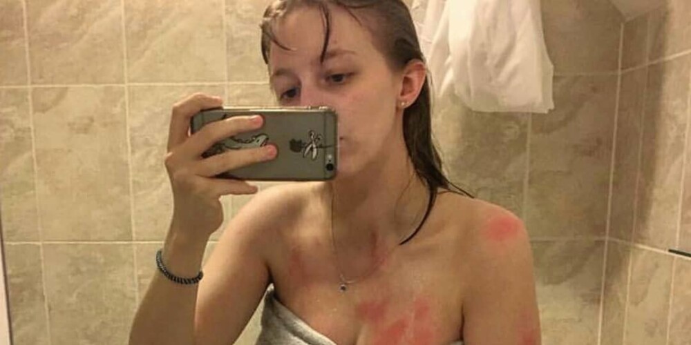 Ожоги от слез: девушка испугала сеть своими фото с аллергией на воду