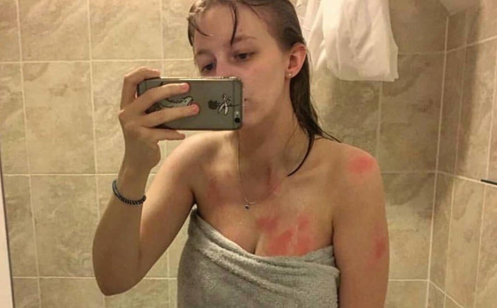 После душа краснеет лицо