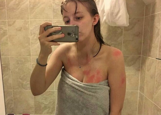 Ожоги от слез: девушка испугала сеть своими фото с аллергией на воду