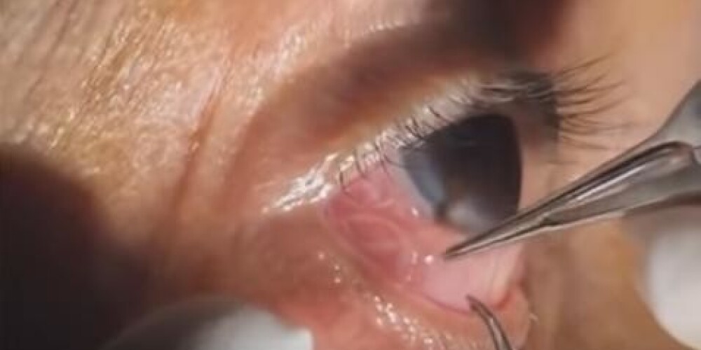 Видео не для слабонервных: из глаза достали извивающегося 15-сантиметрового паразита