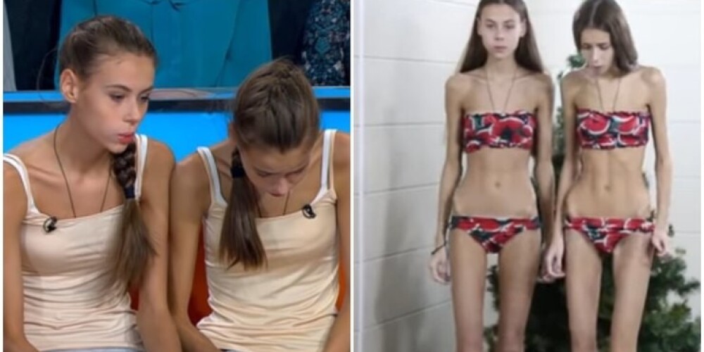 Сестры-близнецы рассказали о борьбе с анорексией на шоу Леры Кудрявцевой