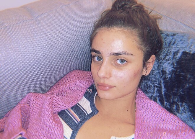 "Ангел" Victoria's Secret опубликовала селфи без макияжа и рассказала о борьбе с акне