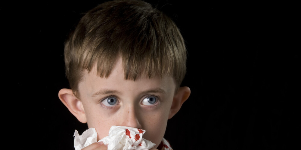 Mazam bērnam asiņo deguns. Kā rīkoties?