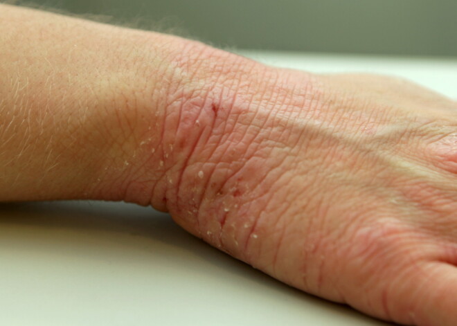 Kad skāris atopiskais dermatīts: kā sadzīvot un ko lietot