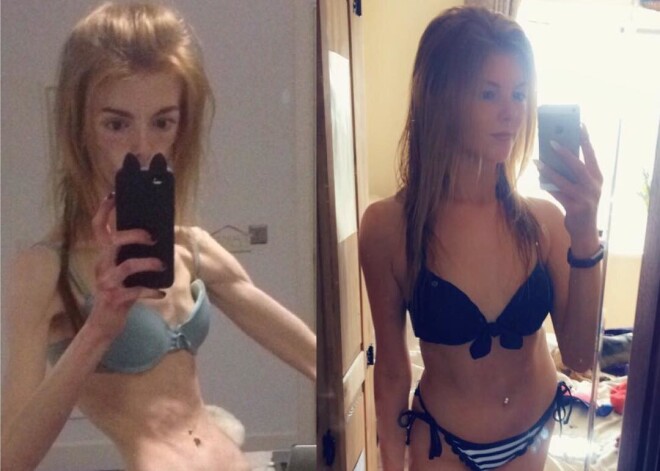 Девушка, весившая 29 кг, изменилась до неузнаваемости, и все благодаря шоколаду