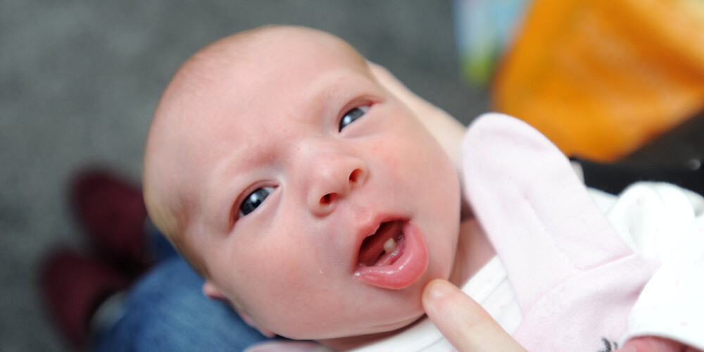Lielbritānijā piedzimis zīdainis ar izaugušu piena zobu