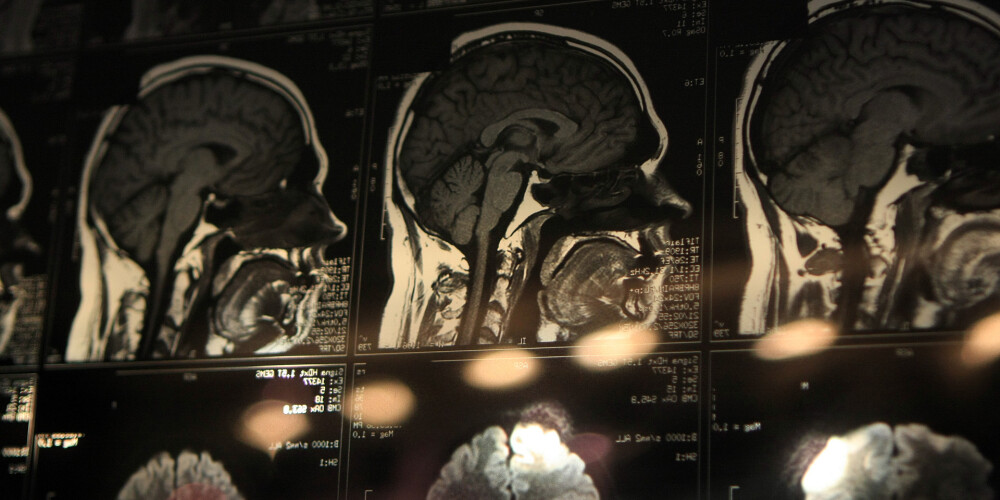 Smadzeņu magnētiskā stimulācija ļauj ārstēt saslimšanas, kurām zāles nelīdz