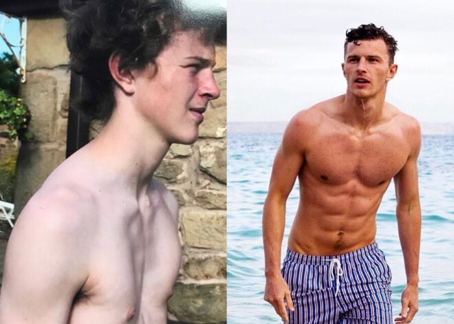 13 лет с железом в ребрах: как парень с впалой грудью стал моделью Calvin Klein