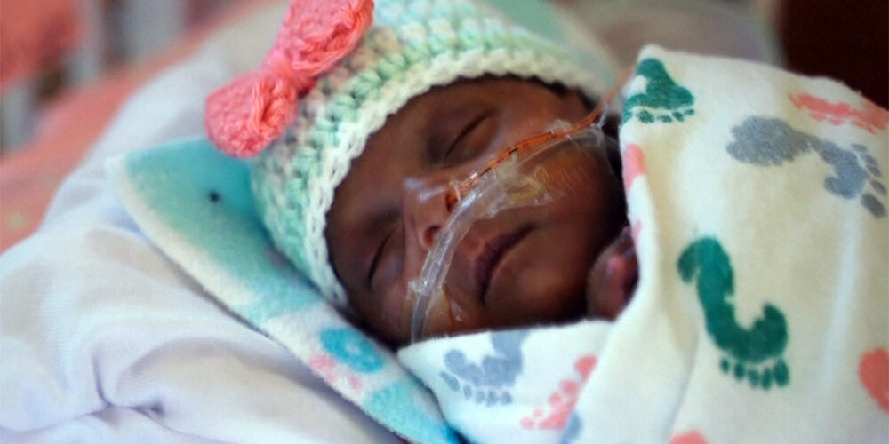 Brīnums Kalifornijā: izdzīvojis pasaulē mazākais bērniņš, kurš piedzimstot svēra tikai 245 gramus